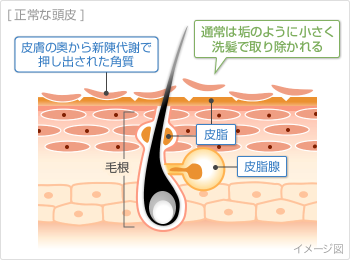 フケ発生のイメージ図