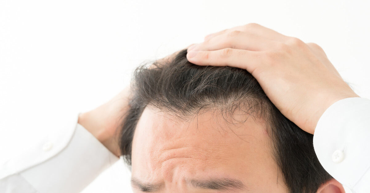 おでこに指何本入るから薄毛だとは一概にいえない