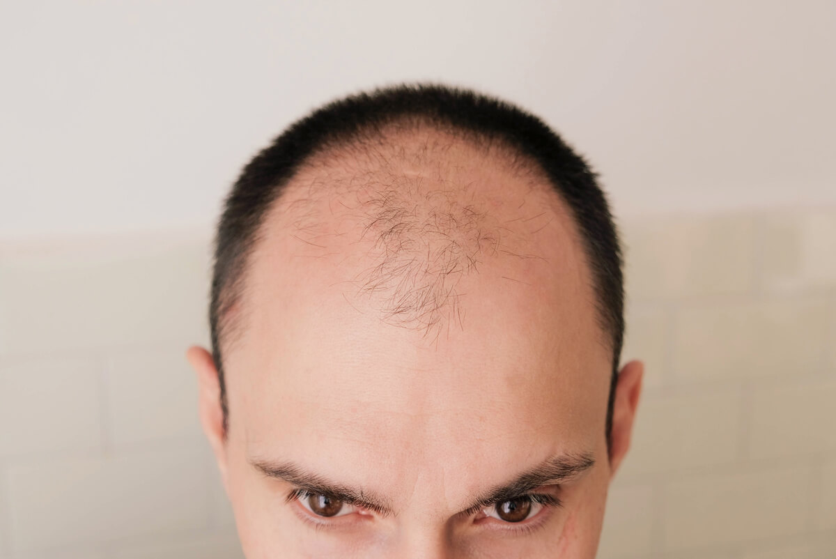 U字はげとは？局所的に薄毛が進みやすい男性は注意